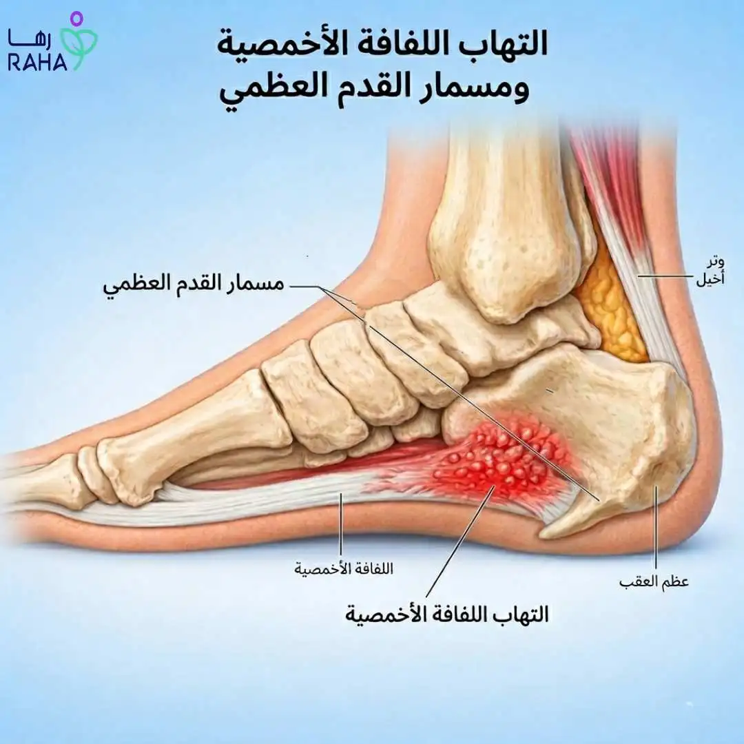 ما هو مسمار القدم العظمي؟